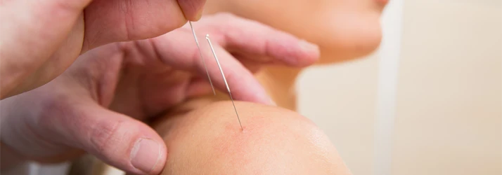 Chiropractic McLean VA Dry Needling